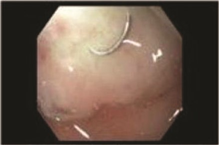 Duodenal bulb ulcer with associated metallic ring in center