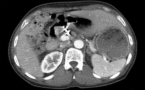 Single axial view of subsequent computed tomography scan demonstrating scattering from GDA coil with associated area suspicious for ulcer in duodenal bulb