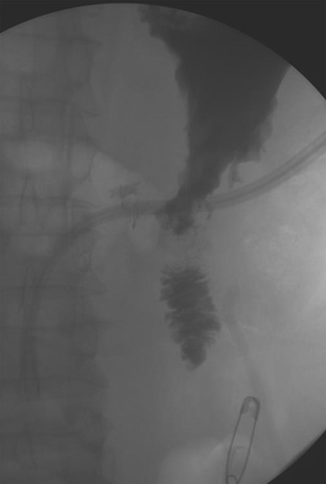 POD1 Swallow study demonstrating a patent gastrojejunostomy