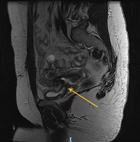 Preoperative magnetic resonance (MR) abdomen, sagittal plane. Arrow indicating vesicovaginal fistula