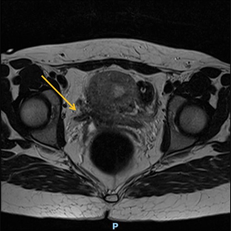 Preoperative MR abdomen, transverse plane. Arrow indicating obstructed right ureter
