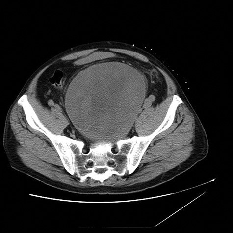 Axial view of CT abdomen and pelvis shows a 13 × 14 cm presacral pelvic mass.