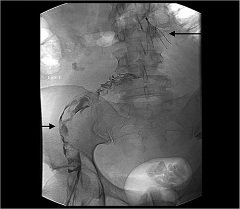 Right Iliac vein and lower IVC thrombosis.