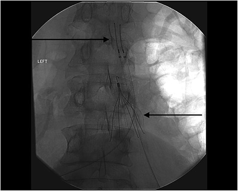 IVC filter and bilateral intravascular catheters to administer thrombolytic (Alteplase and Heparin) therapy. The upper left corner shows the Thrombolytic Catheter and the right lower arrow shows that IVC filter.