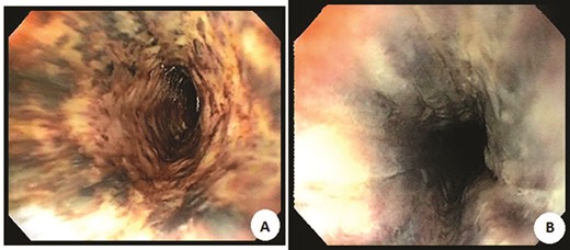 Endoscopic images of the proximal (A) and distal (B) black esophagus.