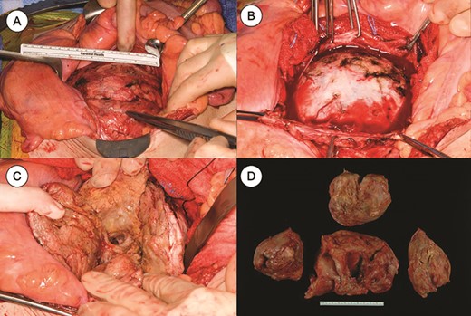 A large pelvic mass was exposed (A, B), and removed carefully through pieces (C, D).