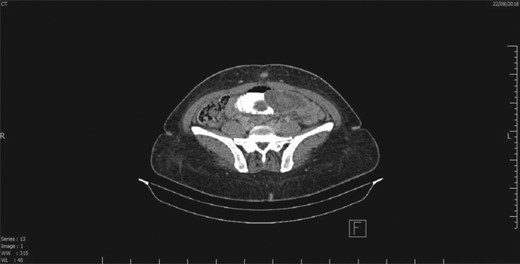 CT scan showing a segment of intestine telescoping into another, which is suggestive of intussusception.