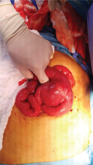 Intussusception of small intestine toward jejuno-jejunal anastomosis.