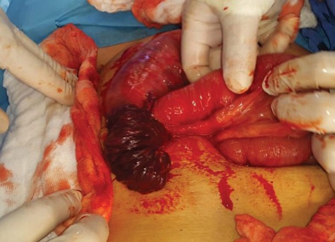 Intussuscepted gangrenous part of the small intestine after reduction of intussusception.