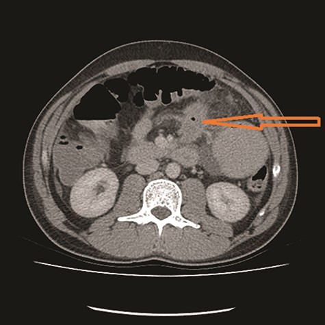 Jejunal mass with local infiltration (see arrow).