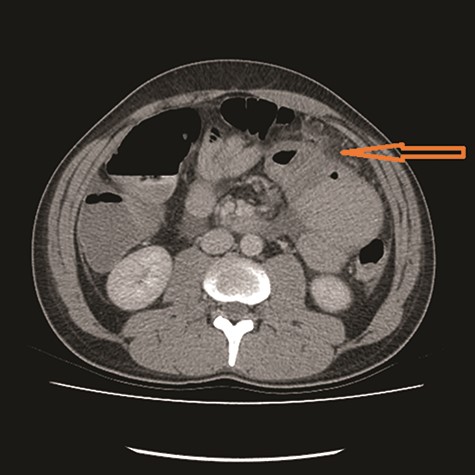 Carcinomatosis (see arrow).