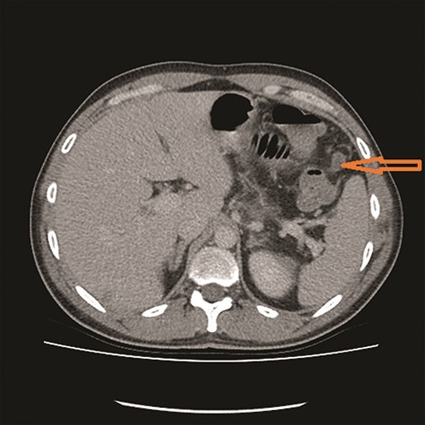 Soft tissue nodule as a feature of carcinomatosis (see arrow).