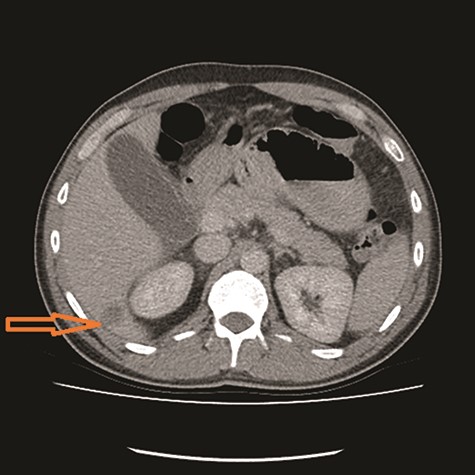 Hepatic metastasis (see arrow).