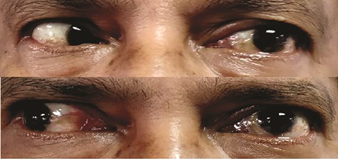 Presence of restricted left extraocular muscles movement on temporal gaze (TOP) and nasal gaze (BOTTOM).