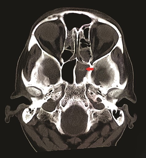Axial view of non-contrasted CT bone window showed ‘double density’ sign within the left sphenoid sinus (red arrow); there was hyper attenuation observed in the centre of the sinus with surrounding mucosal thickening, suggestive of fungal concentration.