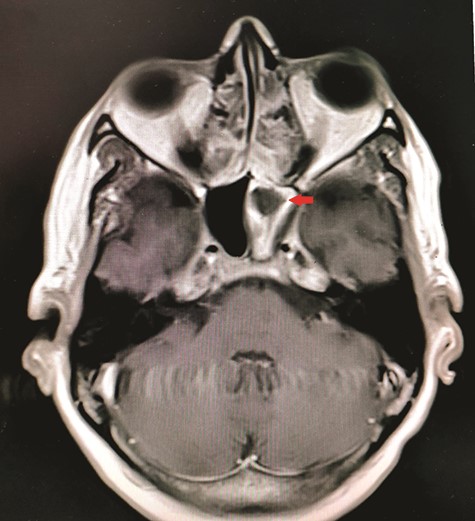 Axial view of MRI T1 weighted post-contrast showed hypodensity within the left sphenoid sinus with surrounding inflammation (red arrow).