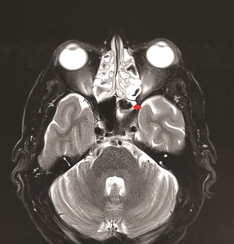 Axial view of MRI T2 weighted revealed flow void signal within the left sphenoid sinus.