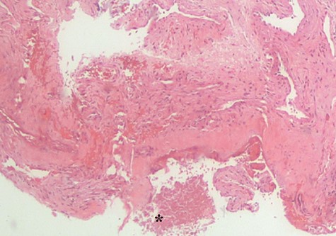 Histopathological examination revealed fungal body (*). No evidence of mucosa invasion was observed.