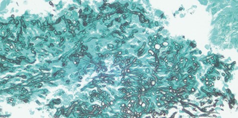 Gomori’s methenamine silver (GMS) stain of Candida species evidenced by its septate hyphae with characteristic dichotomous branching at an angle of approximately 450.