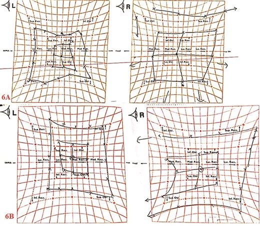 Hess screen chart showed overall improvement of the left extraocular muscle movements; pre-operation (6A); 4-weeks post-operation (6B).