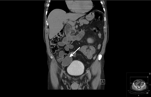 Coronal view of CT showing a well-circumscribed hypodense mass in the right iliac fossa.
