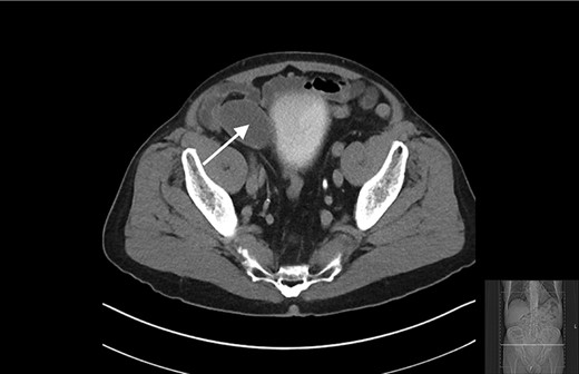 Transverse view of CT showing a well-circumscribed hypodense mass in the right iliac fossa.