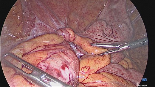 Laparoscopic view of torsion of the appendix.