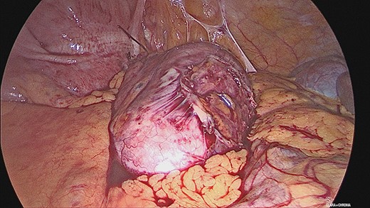 Laparoscopic view of appendiceal mucocele.