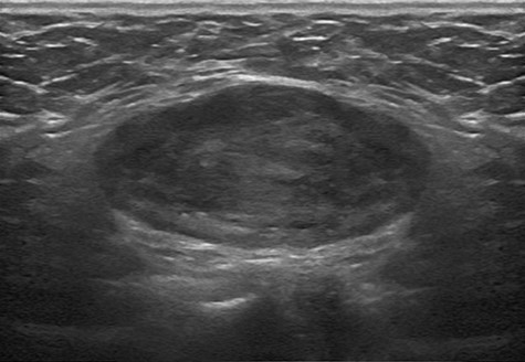 Ultrasonographic findings of the tumor in Case 1. A 9 × 3 cm hypoechoic, well-marginated mass was present in the left inguinal area.
