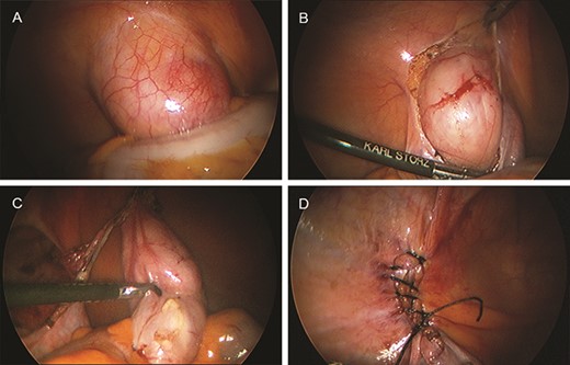 (A) Laparoscopic view of the internal ring. A round mass is evident. (B) Dissection of the peritoneum. (C) Complete excision of the tumor. (D) Closure of the internal ring.