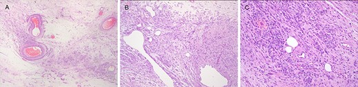 Pathologic findings of angioleiomyoma in the canal of Nuck. (A) Edematous background. (B) Spotty vascular congestion and venous proliferation of various sizes. (C) Differentiation in smooth muscle cell gathered with compact (hematoxylin and eosin staining).