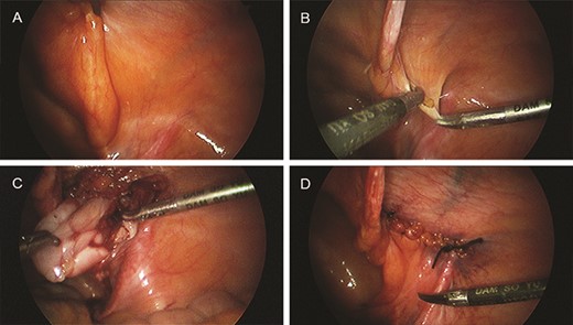 (A) Laparoscopic view of the internal ring. (B) Dissection of the peritoneum. (C) Complete excision of the tumor. (D) Closure of the internal ring.