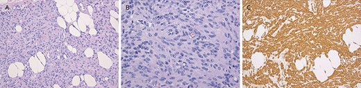 Pathologic findings of lipoleiomyoma in the canal of Nuck. (A) Diffuse solid monotonous cell proliferation intermixed with mature adipose tissue and myxoid edematous stroma is noted on hematoxylin and eosin staining. (B) Proliferative area of cellular spindle cells with elongated and vesicular nuclei and a lack of adipose tissue on hematoxylin and eosin staining. (C) Diffuse and strong positive reaction to proliferating tumor cells on smooth muscle actin staining.