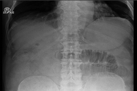 dilated small bowel.