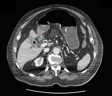 gas in the gallbladder.
