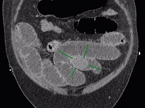 gallstone in distal ileum.