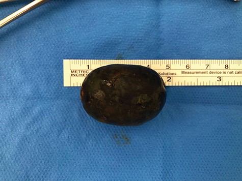 43-mm gallstone.