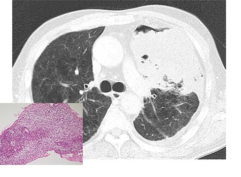 Chest computed tomography after tube thoracostomy. A large tumor with irregular margins occupied the left thoracic cavity. Percutaneous needle biopsy showed a malignant sarcomatoid neoplasm, which was suggestive of malignant triton tumor (left bottom).