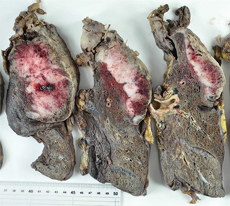 Cut surface of the resected tumor and left lung showing extensive tumor necrosis and invasion into the left upper lobe parenchyma.