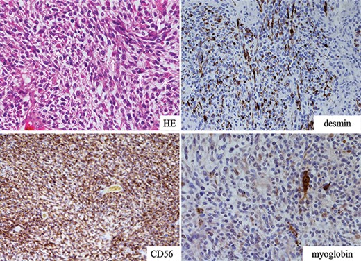 Microscopic view of the resected tumor. Short spindle-shaped sarcomatoid tumor cells with myxoid background showing patternless proliferation revealed positive staining for desmin, myoglobin and CD56. Larger cells with eosinophilic cytoplasm represented rhabdomyoblastic differentiation (white arrows).