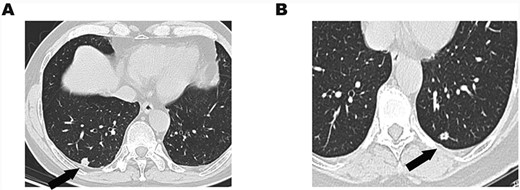 (A) Chest CT showed an 11-mm solitary nodule with central cavity in the right S10 segment. (B) An 8.5-mm solitary nodule with central cavity in the left S10 segment.