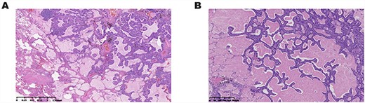 (A) Postoperative pathological analysis showed ciliated columnar cells were coated on the surface of adenoid or papillary structures, and basal cells were located in the outer layer. (B) Histopathological findings showed ciliated columnar cells with mucous lakes.