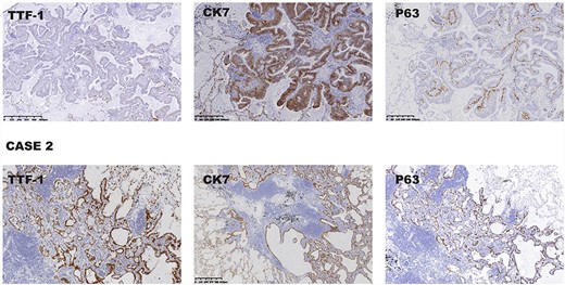 (Case 1) The immunohistochemical profile of the ciliated columnar cells and mucous cells showed that TTF-1, CK7 and P63 were positive. (Case 2) Representative photographs showing positive immunohistochemistry results for TTF-1, CK7 and P63.