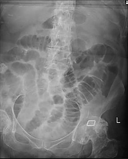 Plain abdominal X-ray at presentation demonstrating gallstone as well as distended loops of small bowel.