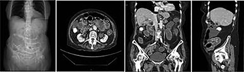 a,b,c,d: CT images scout, axial, coronal and sagittal planes, respectively demonstrating gallstone as well as distended loops of small bowel.