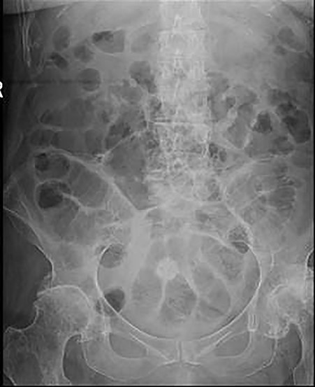 Follow-up abdominal X-ray revealed the gallstone in the rectum and that bowel obstruction has now resolved.