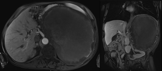 The coronal and axial MRI images of the PCC