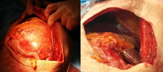 Our Chevron incision before and after adrenalectomy