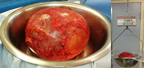 The tumor after complete removal