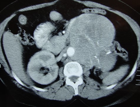 CT scan coronal image showing a large recurrence in left renal bed.